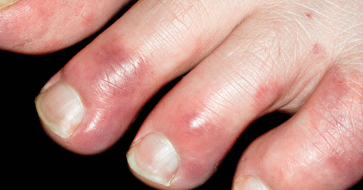 Link Between Chilblains and Vitamin Deficiency